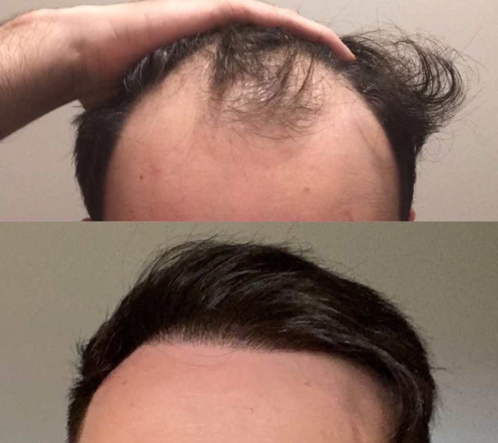 Hair Transplant - 5,000 Hairs