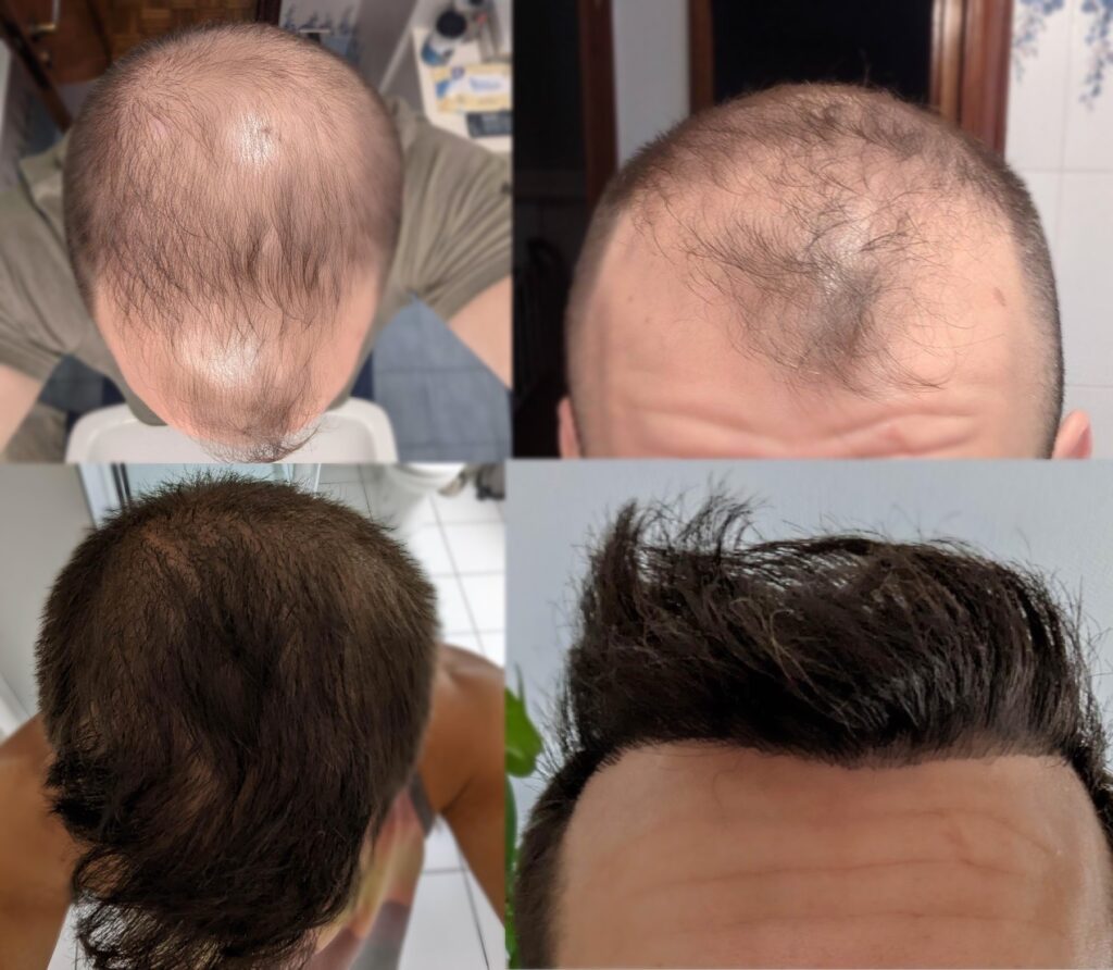 Hair Transplant FUE Results